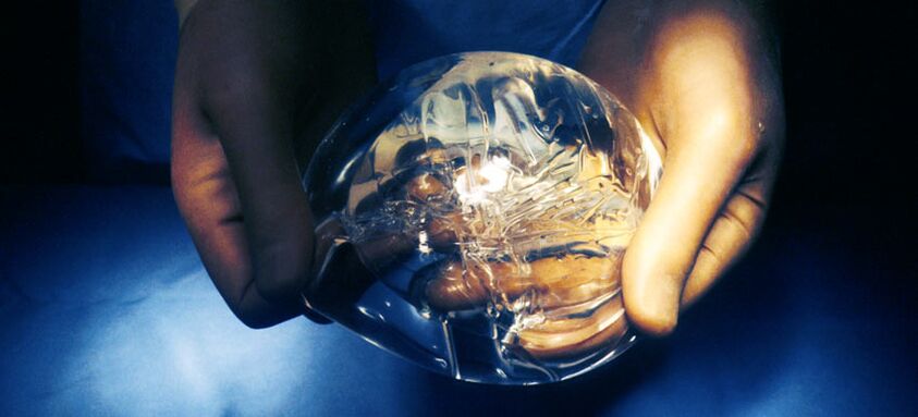 Silikonazko endoprotesia